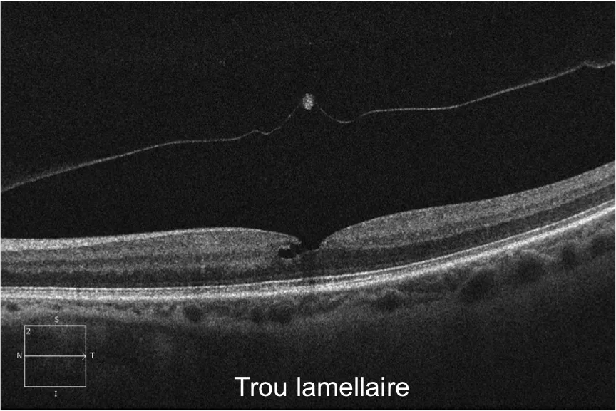 trou lamellaire