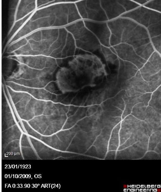 Salle de laser diode pour Photothérapie Dynamique PDT à la Visudyne
