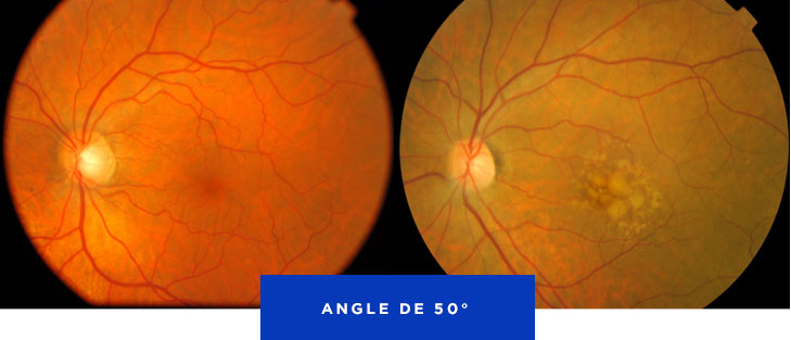 Fond d'œil rétinien — Injection intra-vitréenne Au Centre Ophtalmologique Rabelais