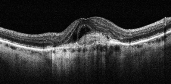 Image OCT d'une DMLA humide avec néovaisseaux choroïdiens