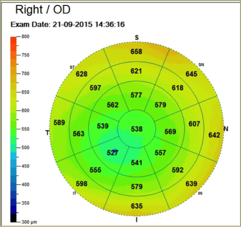 Pachymétrie cornéenne non contact par OCT