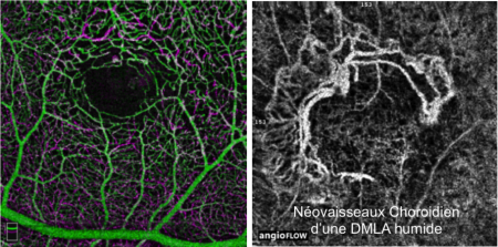 Angiographie à la fluorescéine — néovaisseaux choroïdiens (DMLA humide)
