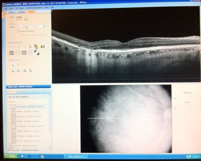 Résultat d'un examen OCT maculaire sur écran de contrôle