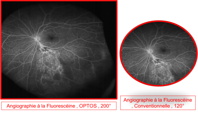 Comparaison angiographie conventionnelle vs grand champ