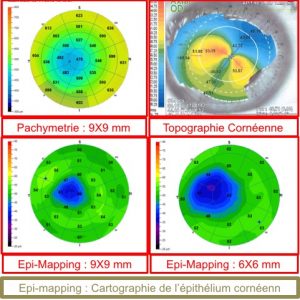 Epi-Mapping d'un kératocône comparé à la pachymétrie totale