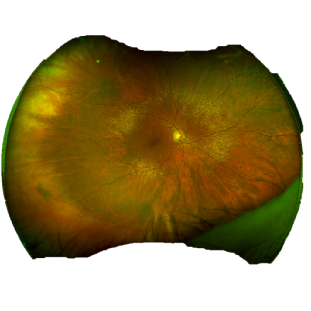 Rétinographie Optos grand champ de 200° du fond d'œil
